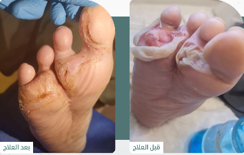 حالة علاج 2
